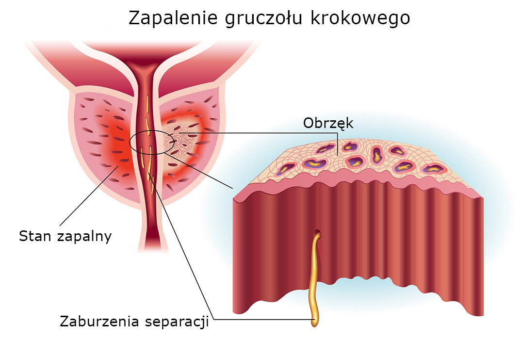 zapalenie prostaty